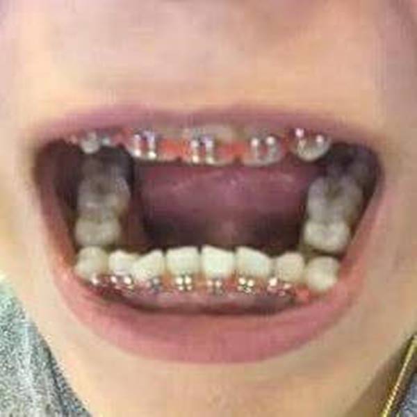 จัดฟันเถื่อน