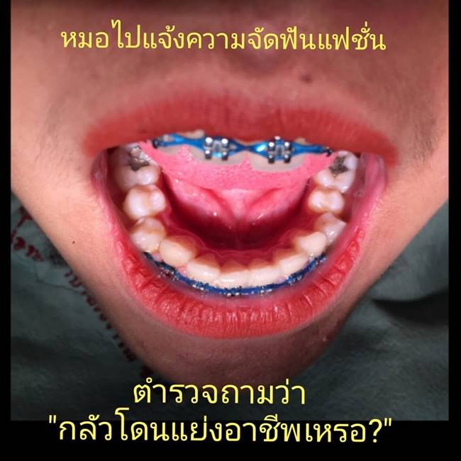 จัดฟันแฟชั่น