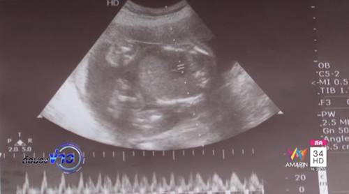 วินิจฉัยท้องแฝดผิดพลาด