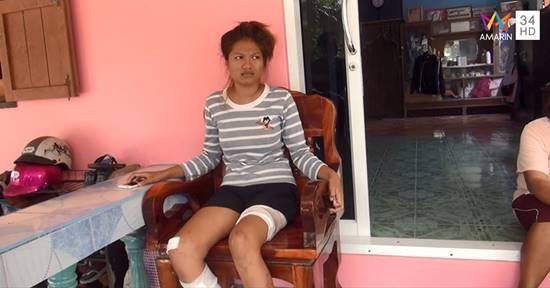 สาวเหยื่อฝูงร็อตไวเลอร์ขย้ำ