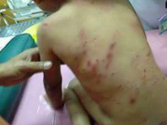 หมากัดเด็ก