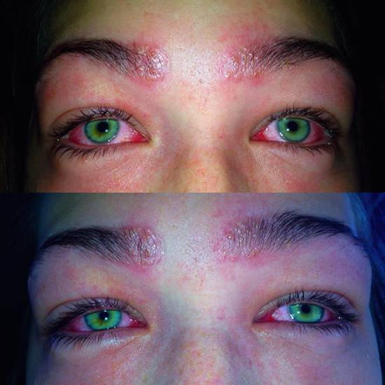 สาวสะพรึงแรง ตาหวิดบอดเพราะแพ้สารในสีย้อม หลังย้อมขนตา-ขนคิ้ว