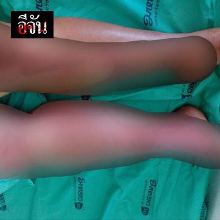 2 แม่ลูกเอาน้ำมันร้อน ๆ ราด 