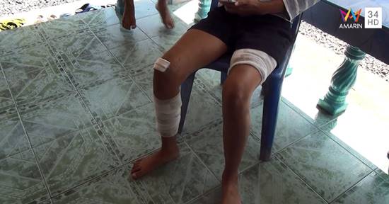 สาวเหยื่อฝูงร็อตไวเลอร์ขย้ำ