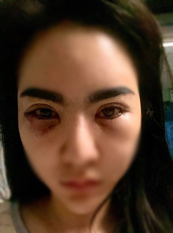 สาวฉีดฟิลเลอร์