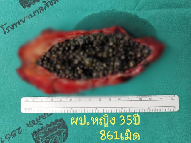 นิ่วในถุงน้ำดี