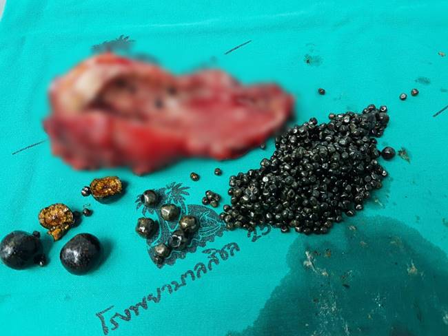 นิ่วในถุงน้ำดี