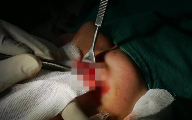 สาวฉีดฟิลเลอร์