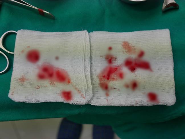 สาวฉีดฟิลเลอร์