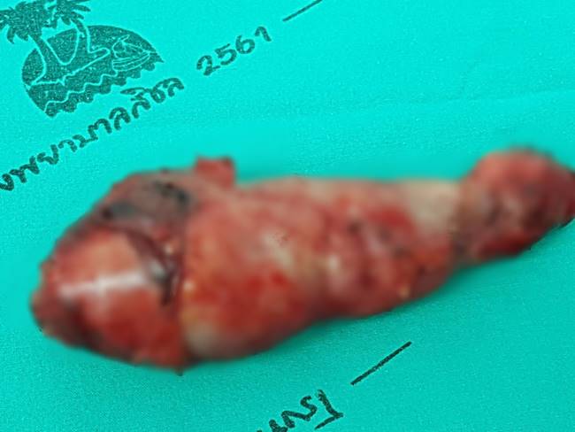 นิ่วในถุงน้ำดี