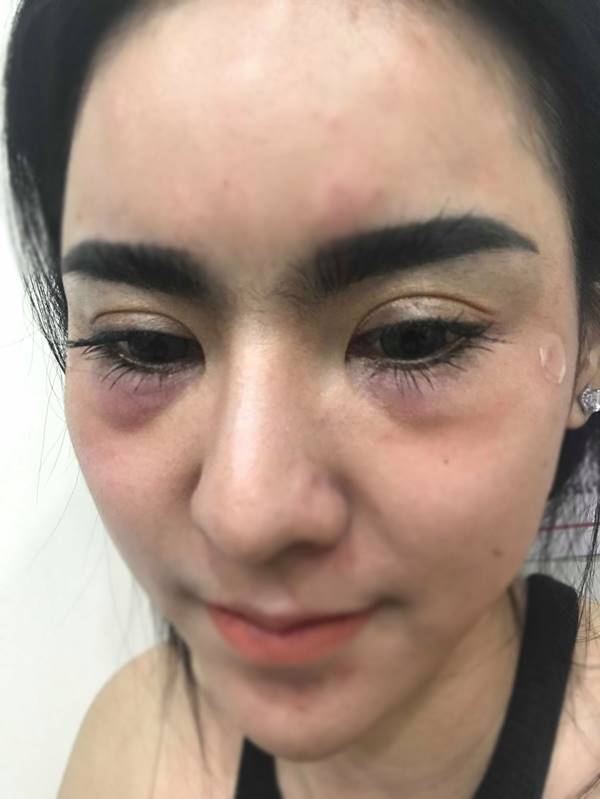 สาวฉีดฟิลเลอร์