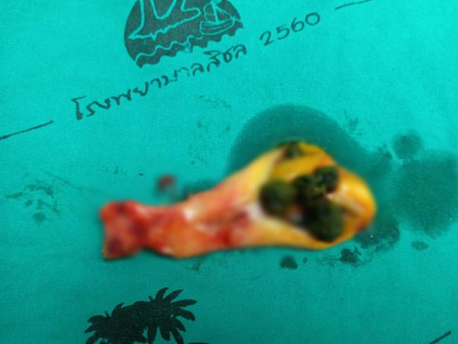 นิ่วในถุงน้ำดี