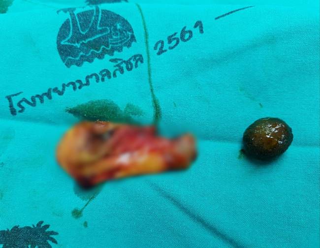 นิ่วในถุงน้ำดี