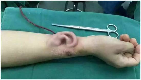 สุดล้ำ ! แพทย์จีนปลูกหูเทียมชั่วคราวที่แขนคนไข้ 