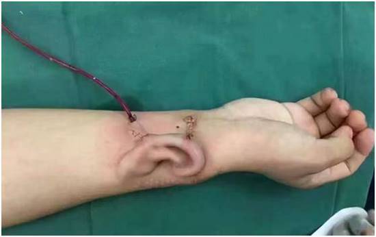 สุดล้ำ ! แพทย์จีนปลูกหูเทียมชั่วคราวที่แขนคนไข้ 