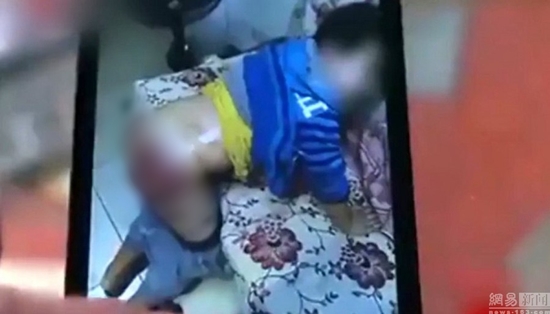 ครูอำมหิต คว้าด้ามไม้กวาดกระหน่ำฟาดก้นเด็กไม่ทำการบ้าน ผิวแตก-ห้อเลือดหนัก