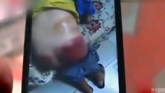 ครูอำมหิต คว้าด้ามไม้กวาดกระหน่ำฟาดก้นเด็กไม่ทำการบ้าน ผิวแตก-ห้อเลือดหนัก