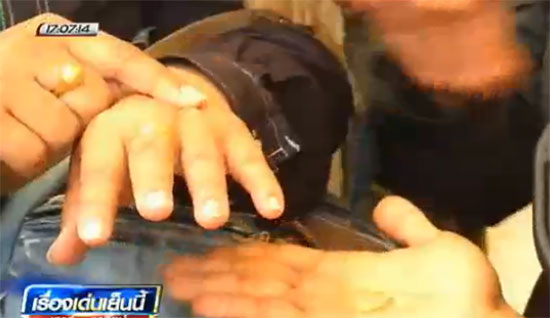 สาวอ้วนขึ้นจนแหวนแต่งงานรัดนิ้ว ปวดจี๊ดถึงสมอง เจ้าหน้าที่โร่ช่วย