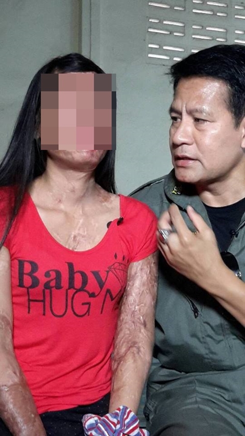 บิณฑ์ รุดช่วยสาววัย 28 ถูกน้ำกรดสาดเสียโฉม-ตาบอด 5 ปี คดีไม่คืบ