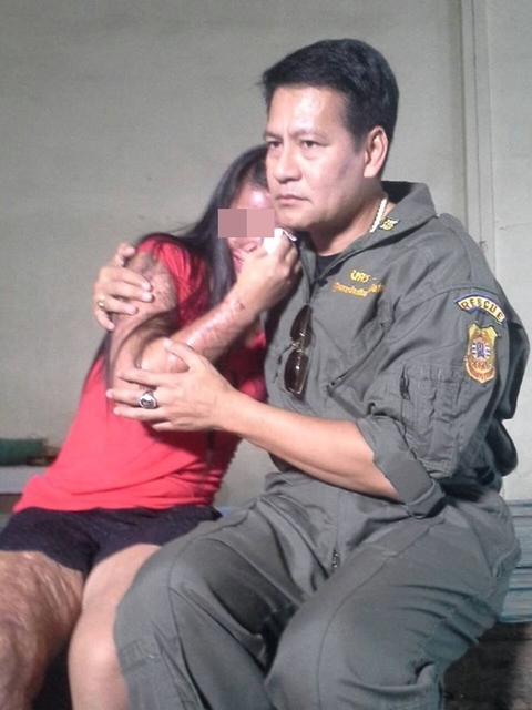 บิณฑ์ รุดช่วยสาววัย 28 ถูกน้ำกรดสาดเสียโฉม-ตาบอด 5 ปี คดีไม่คืบ