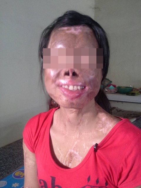 บิณฑ์ รุดช่วยสาววัย 28 ถูกน้ำกรดสาดเสียโฉม-ตาบอด 5 ปี คดีไม่คืบ