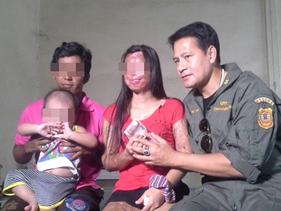 บิณฑ์ รุดช่วยสาววัย 28 ถูกน้ำกรดสาดเสียโฉม-ตาบอด 5 ปี คดีไม่คืบ