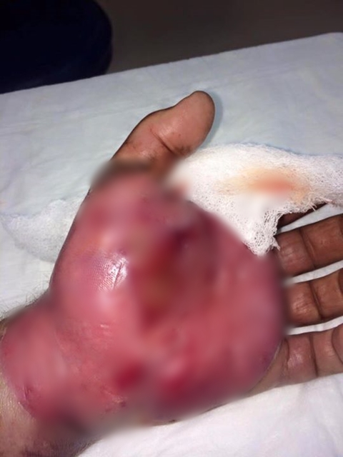 สยองหนักมาก นักดนตรีโชว์ภาพแผลงูหางกระดิ่งกัด บวมเป่งเป็นลูกโป่ง