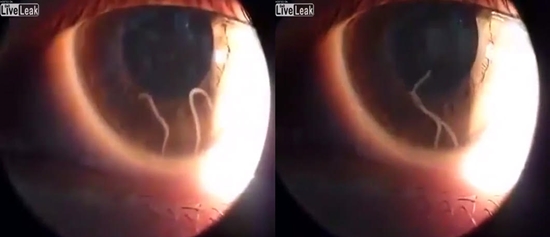 เมื่อพยาธิตัวยาวดิ้นดุกดิก เคลื่อนไหวไปมาอยู่ในลูกตา