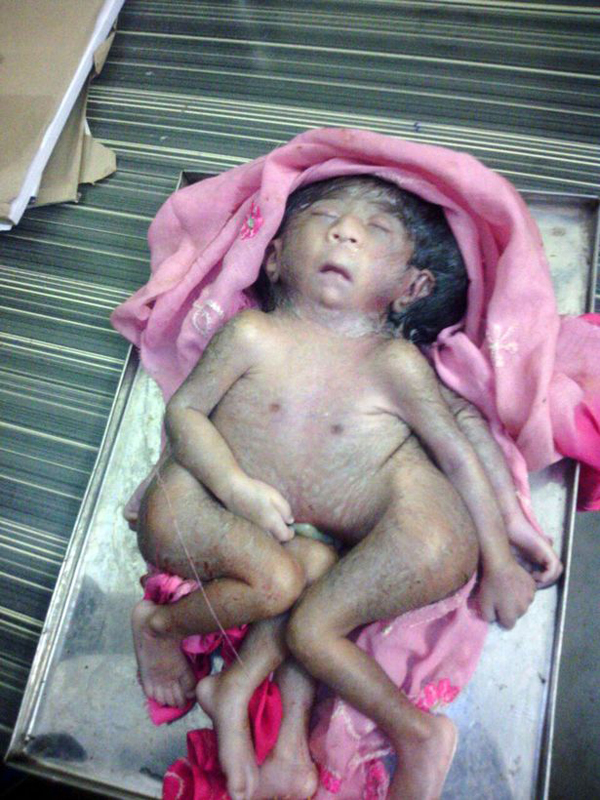 แห่บูชา ทารกมี 4 แขน 4 ขา เชื่อเป็นร่างอวตารพระพิฆเนศวร