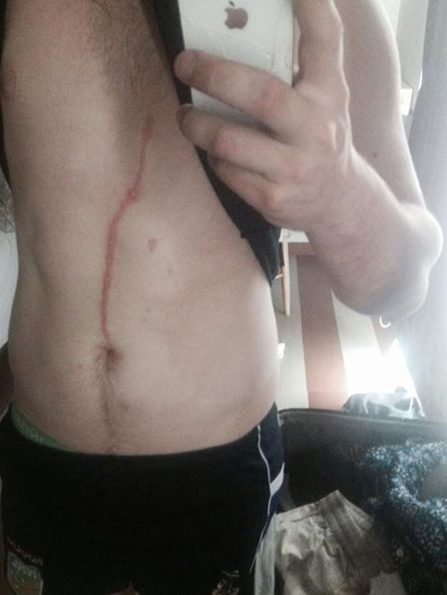 ขนลุก แมงมุมฝังตัวใต้ผิวหนังหนุ่มออสซี่ ขุดโพรงจนเป็นทางยาวแบบนี้ ขนลุก แมงมุมฝังตัวใต้ผิวหนังหนุ่มออสซี่ ขุดโพรงจนเป็นทางยาวแบบนี้