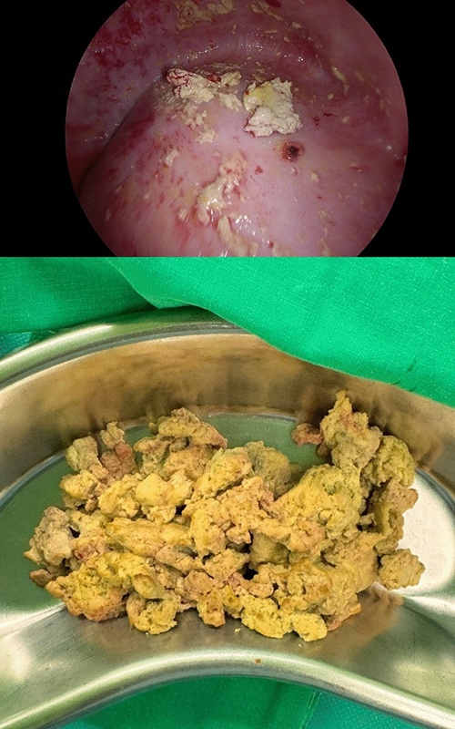 ปอดมีหนอง