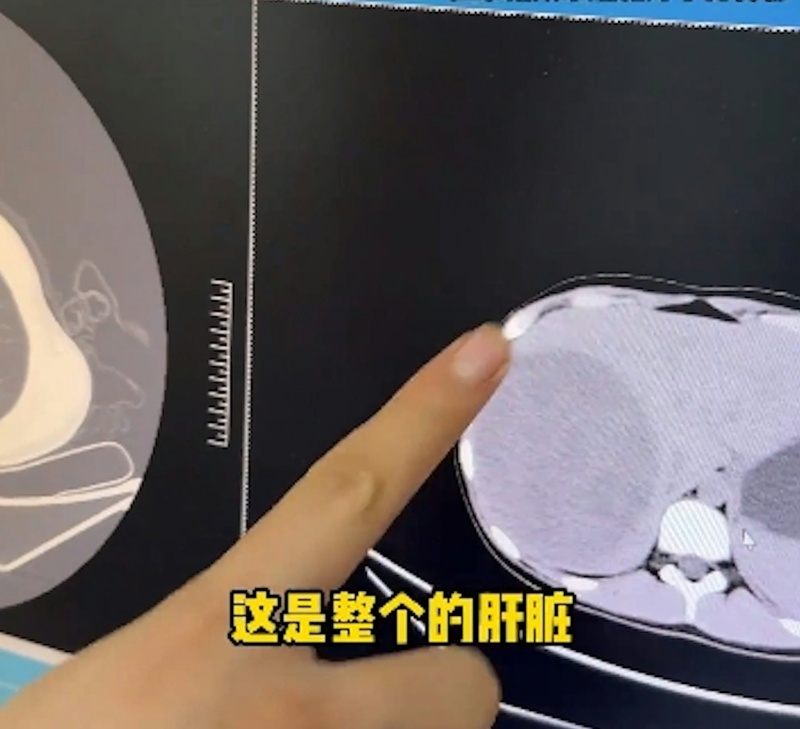 เด็กหญิงวัย 15 เป็นมะเร็งตับระยะสุดท้าย