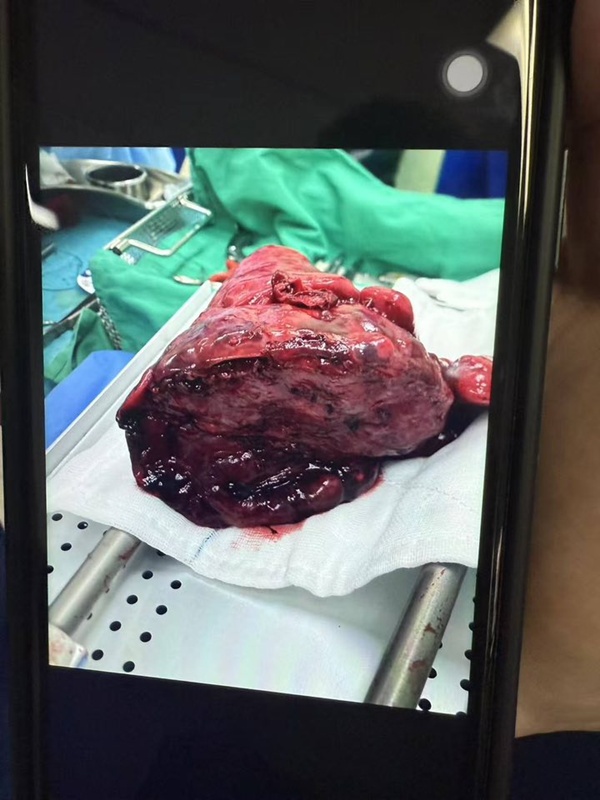 ดูดพอตทางจมูก 2 ปี เปลี่ยนชีวิต