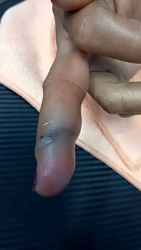 เตือนภัยจากกุ้ง