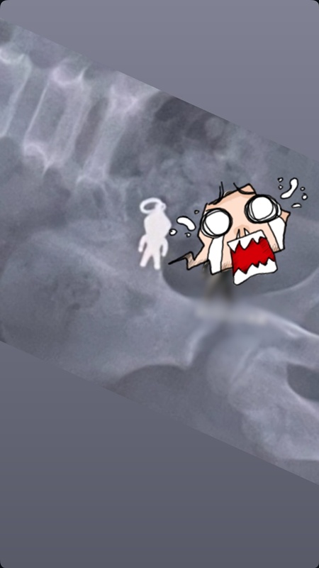 ภาพเอกซเรย์ช็อก ร่างมนุษย์จิ๋ว