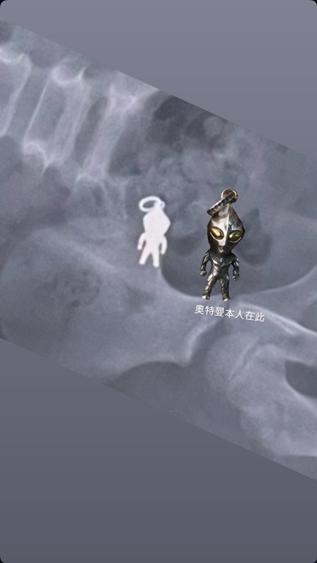 ภาพเอกซเรย์ช็อก ร่างมนุษย์จิ๋ว