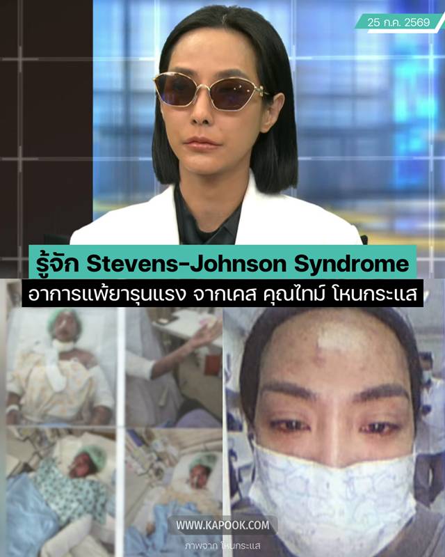 Stevens-Johnson Syndrome