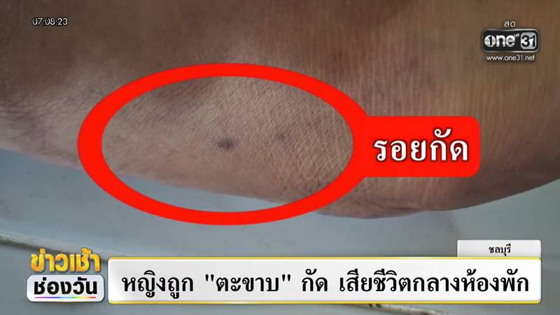 หญิงถูกตะขาบกัด