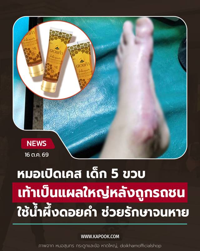 รักษาแผล รักษาแผล