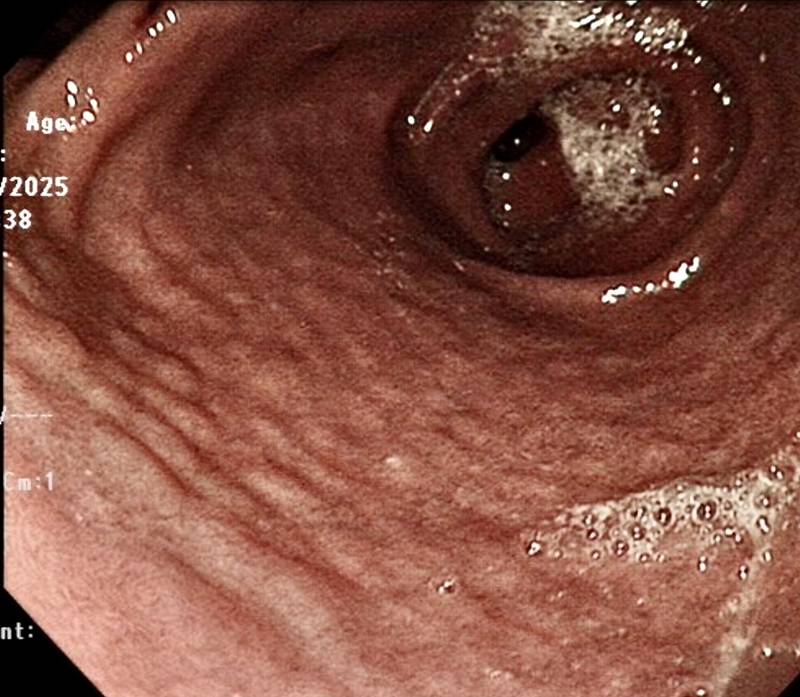 เด็กอ้วกเป็นเลือด