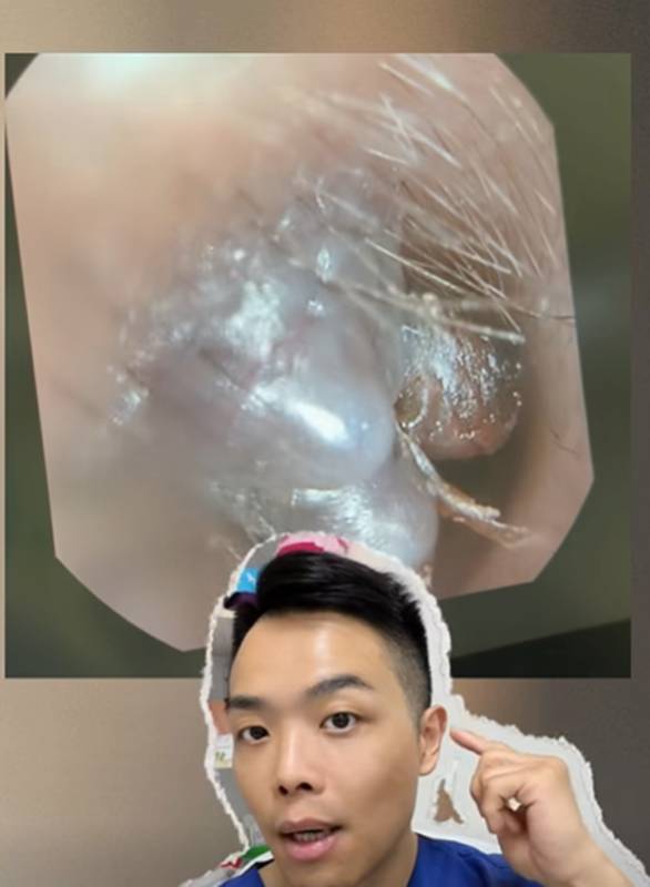 ก้อนปริศนาในหู