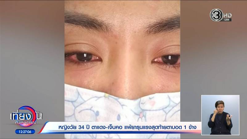 แพ้ยาตาบอด