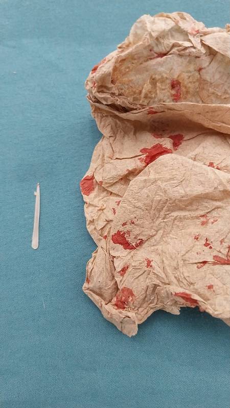 ก้างปลาติดคอ