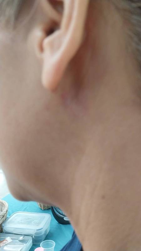 ก้างปลาติดคอ