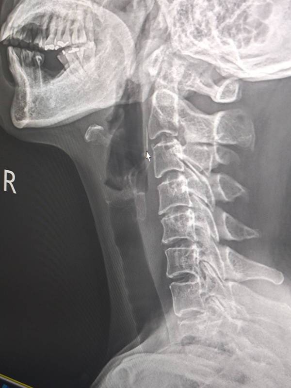 ก้างปลาติดคอ