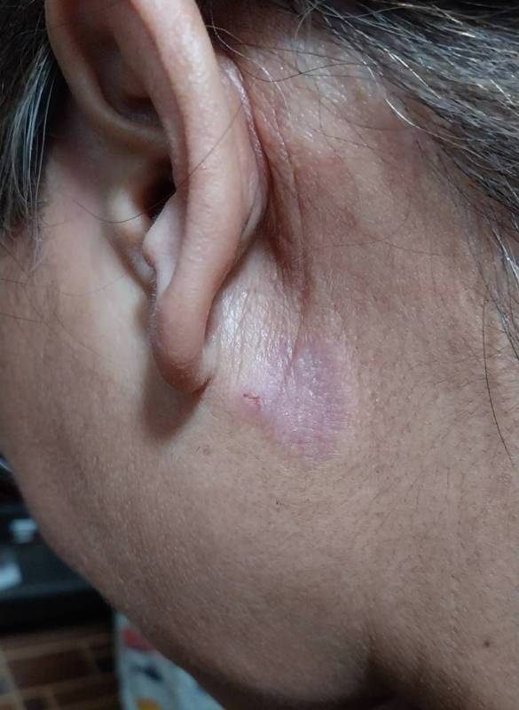 ก้างปลาติดคอ