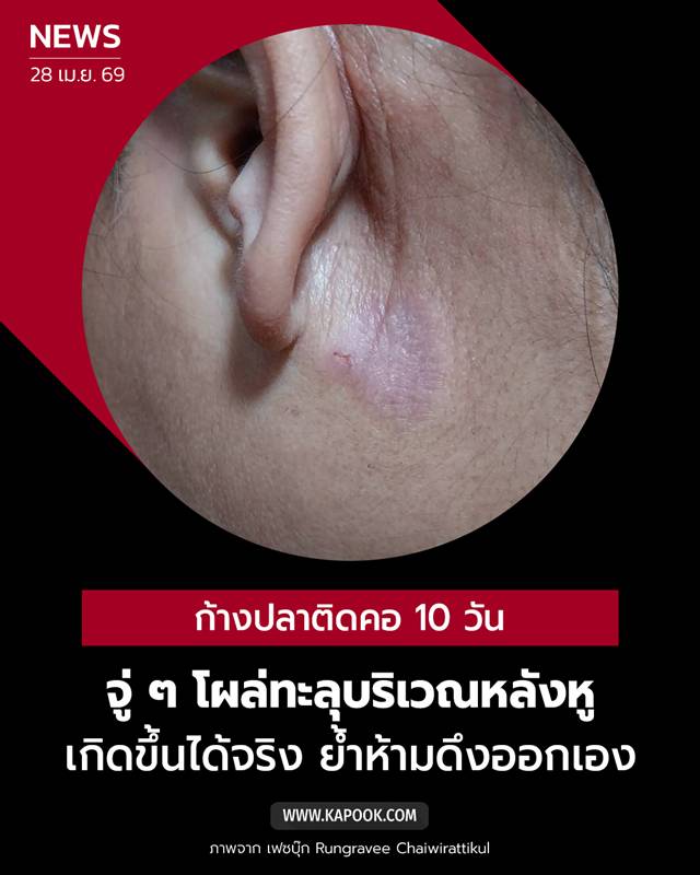 ก้างปลาติดคอ