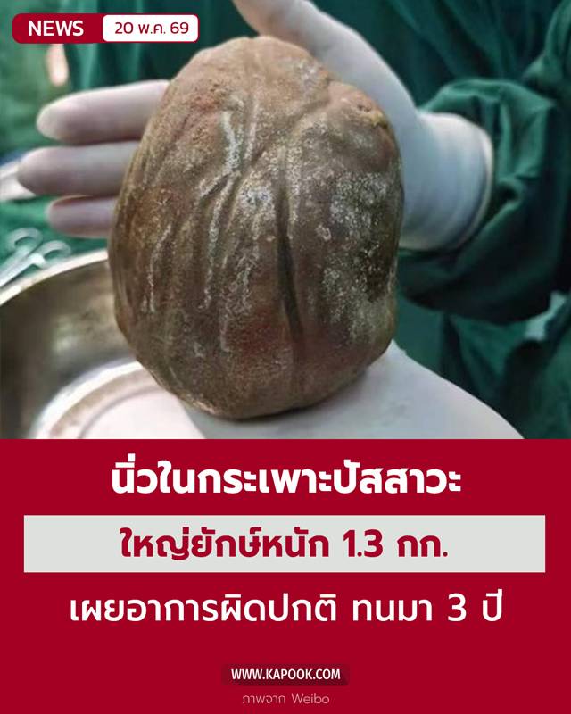 นิ่วในกระเพาะปัสสาวะ