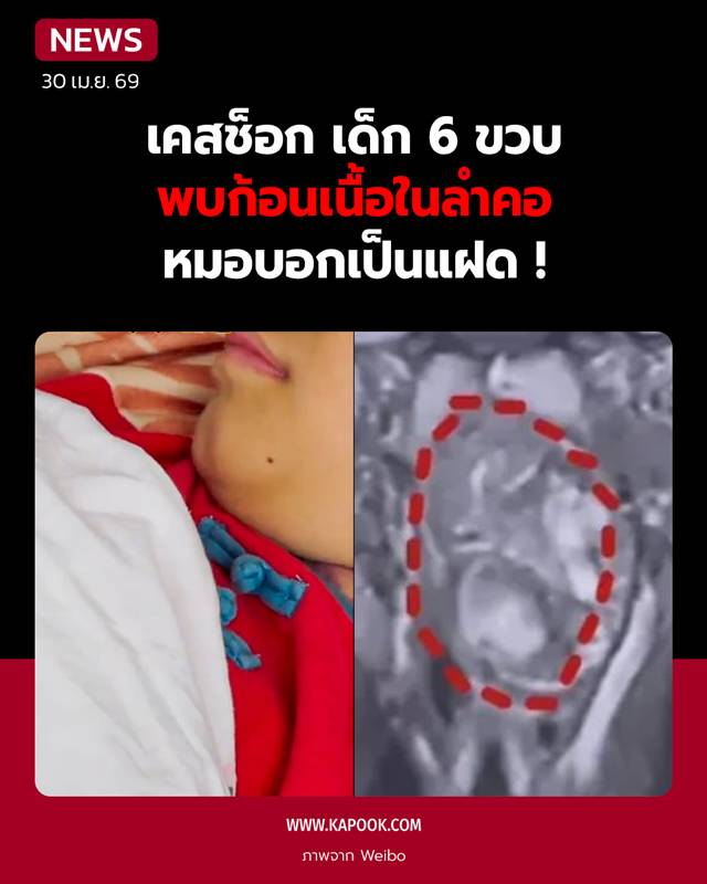 แฝดปรสิต