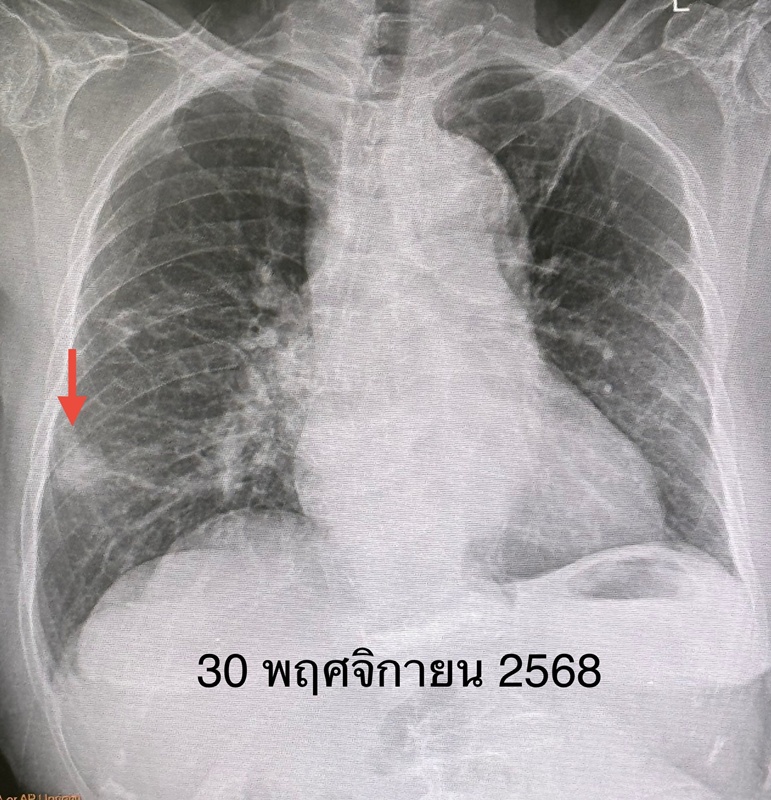 ปอดอักเสบ เพราะนกพิราบ